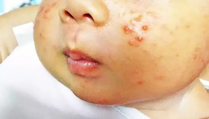 3个月婴儿脸上起红斑,医生:都是母乳惹的祸,很多宝妈都做错