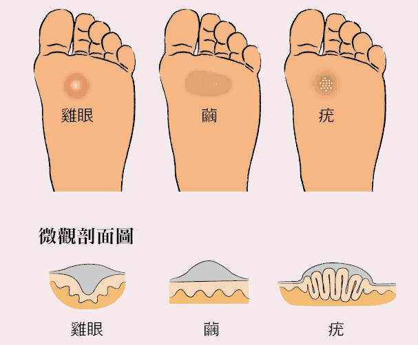 脚底长了鸡眼怎么办,挖掉会再长吗?医生告诉你怎么做