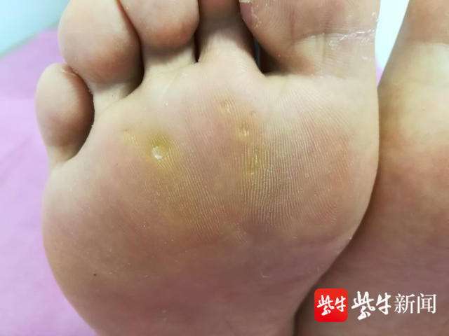 像鸡眼又不是鸡眼脚底长了这种茧不但疼还会传染