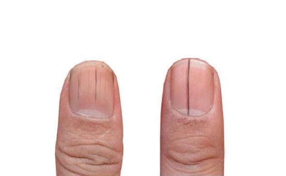 手指甲上出现竖纹,对身体有什么影响呢?医生说出了实话!