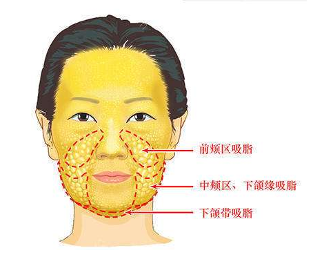 脸这类对于颊脂垫过于饱满的人,就是看上去嘴边两侧的位置脂肪饱满