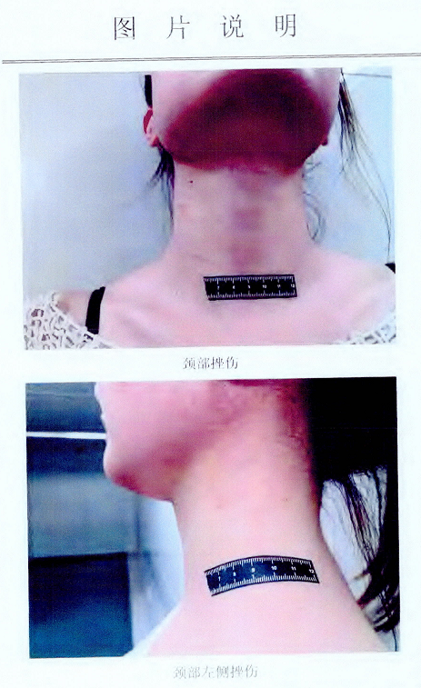 "咱们一起死"姑娘报警男友掐伤自己脖子,男友却说有家庭,她是包养的