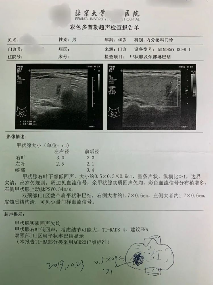 桥本氏甲状腺炎伴甲亢8年反复复发最后一侧腺体结节变成甲状腺癌