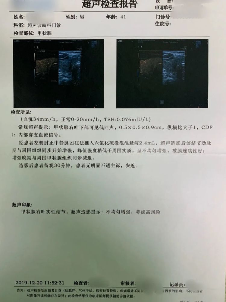 随后患者到北京几家三甲医院复查甲状腺b超均提示:甲状腺右叶下极