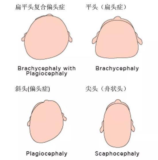 为啥老人都爱给婴儿睡偏头,注意这几点,让宝宝拥有完美头型