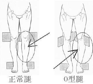 如何自我矫正O型腿？每天只花10分钟，轻松告别罗圈腿
