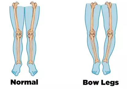 如何自我矫正O型腿？每天只花10分钟，轻松告别罗圈腿