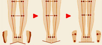 如何自我矫正O型腿？每天只花10分钟，轻松告别罗圈腿