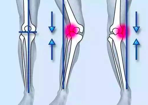 如何自我矫正O型腿？每天只花10分钟，轻松告别罗圈腿