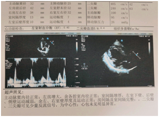 超声心动图:左室射血分数(lvef)40%,左室下壁,后壁,侧壁运动减弱(图2)