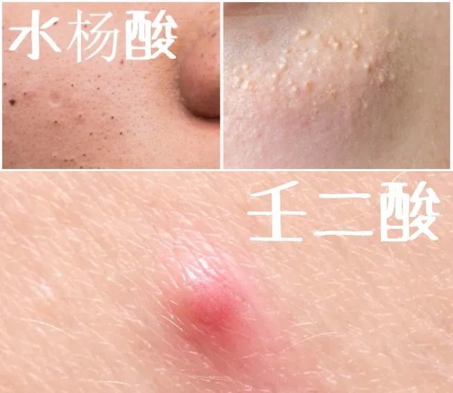 被低估的成分&油痘皮亲妈:壬二酸