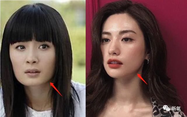 况且从她整体的骨骼和风格来说,也不适合削,一是下颌骨不外翻,不至于
