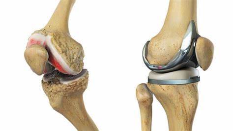 高龄患者是否能进行膝关节置换手术?