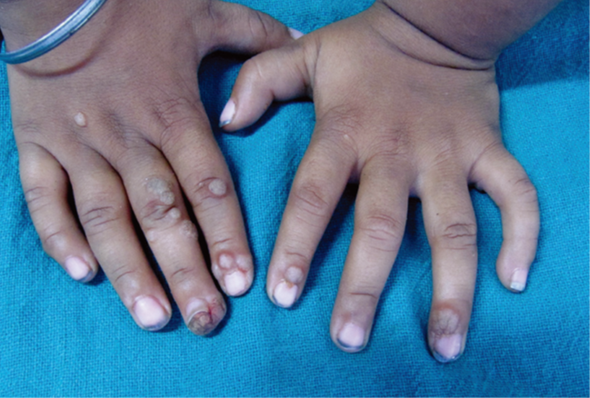 咬指甲也会促使疣在各个手指间传播.