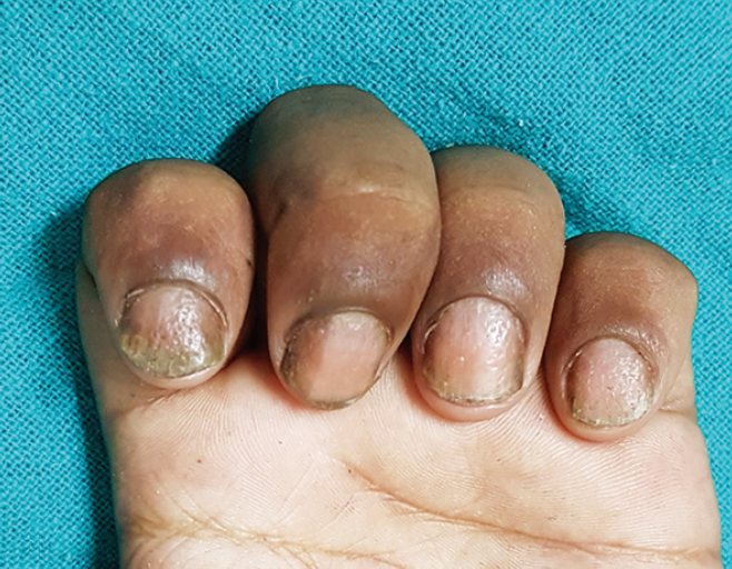 甲银屑病(nail psoriasis)