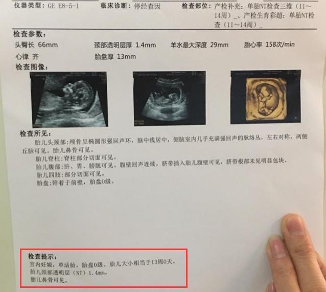nt检查是检查什么,一定要做吗?几乎孕妈都做过,少数单独做