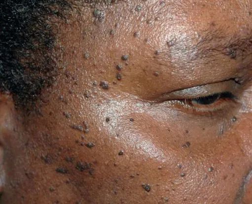 遇到面部褐色丘疹,不要只想到扁平疣.这个病你需要知道