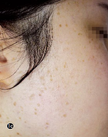 1c)侧面部见肤色或淡褐色丘疹,部分丘疹表面可见黑色或深褐色针尖大小