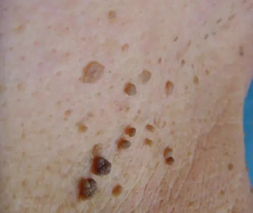 遇到面部褐色丘疹不要只想到扁平疣这个病你需要知道