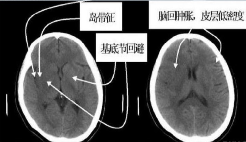 左右滑动查看非增强图像 岛带征,岛带(岛叶皮质,最外囊,屏状核)灰白质