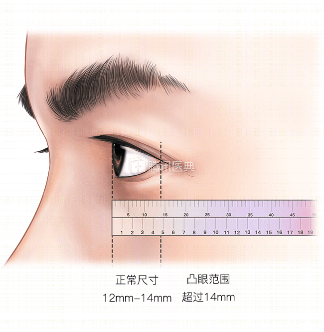 中国人正常眼球突出度在 12~14 毫米,超过 14 毫米即为眼球异常突出.