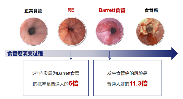 胃食管反流病(gerd)是指胃内容物反流至食管,引起相应的食管症状和