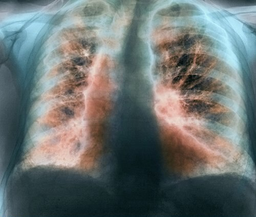 关于特发性肺纤维化的影像学,这5个问题你掌握了吗?