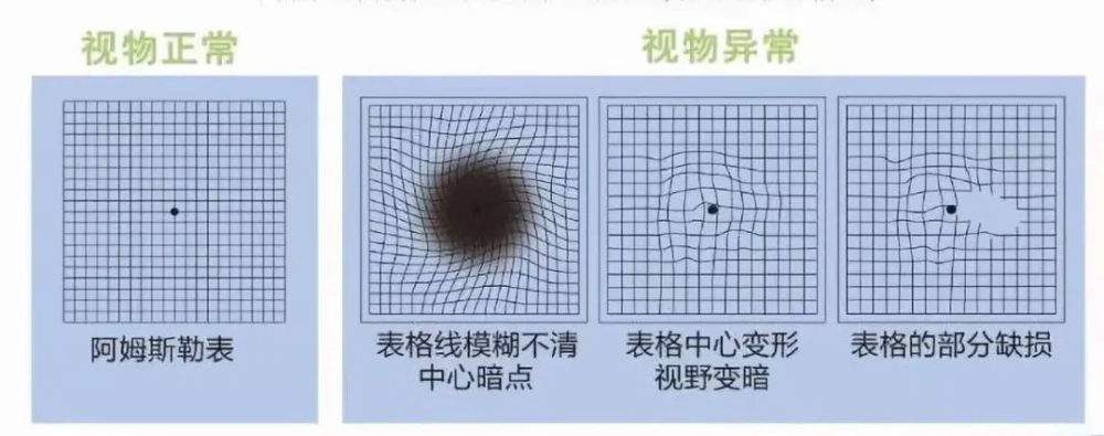 年过五旬看东西变形 眼睛可能患了这个病