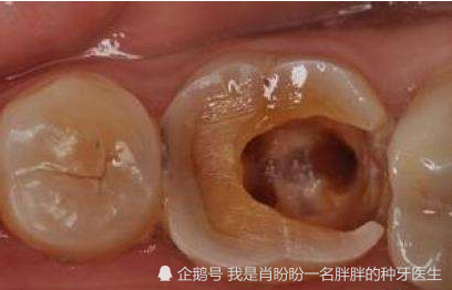 备受牙痛折磨,到底得的是什么牙病?牙医教你区分,教你