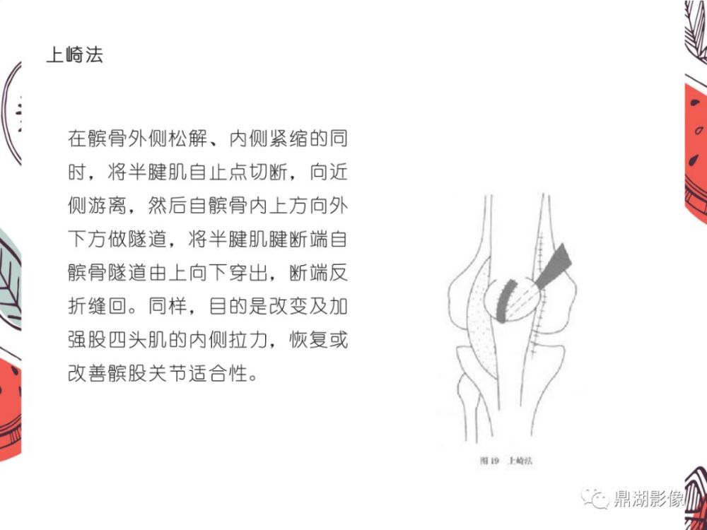 5,压痛:多分布在髌骨内缘及内侧支持带处.