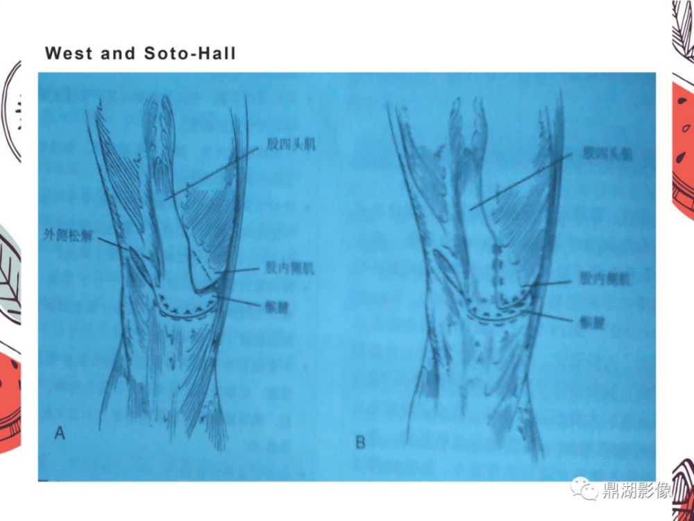 5,压痛:多分布在髌骨内缘及内侧支持带处.