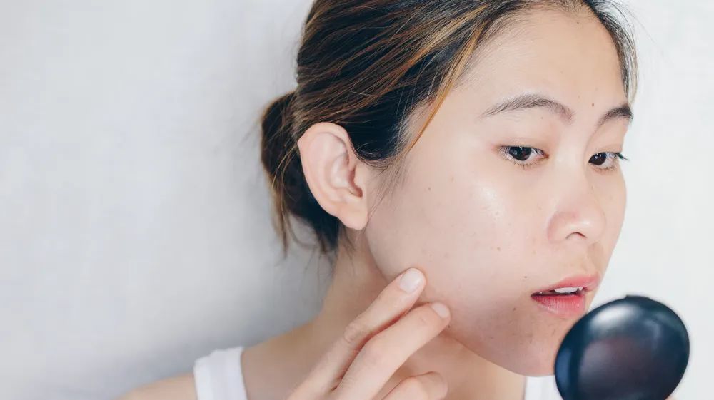 治疗痘痘，有效的外用药有哪些，要注意什么？