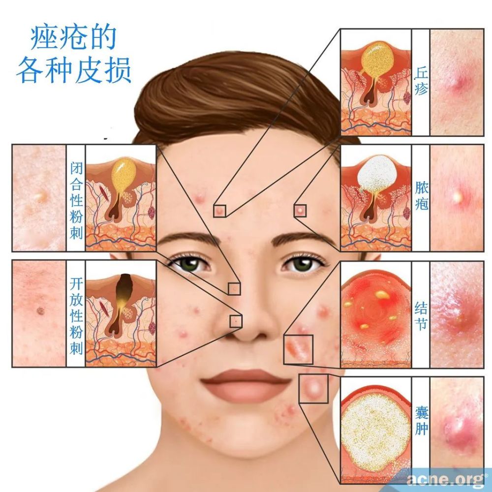 痤疮vs 玫瑰痤疮,傻傻分不清楚