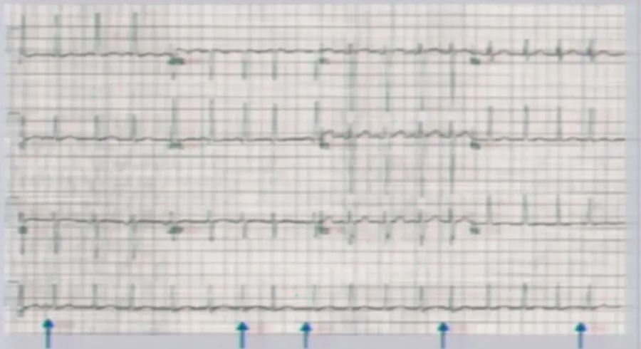 胸导联电压异常增高,呈现rv4>rv5>rv6; 应激性心肌病的表现类似于急性