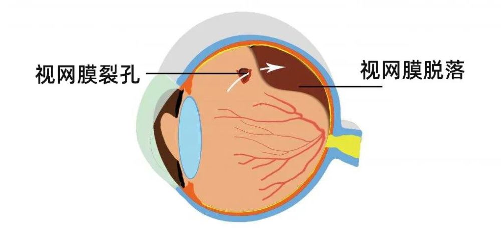 视网膜脱落易导致失明这几种人尤其要注意