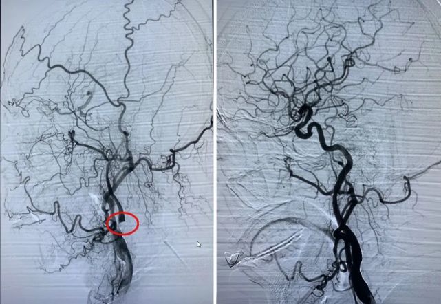 图左圈圈处为颈动脉狭窄处,图右为术后血管开通