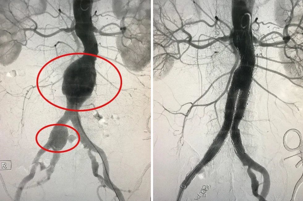 图左为术前,可见腹主动脉瘤和右侧髂总动脉瘤;图右为术后,腹主动脉,髂