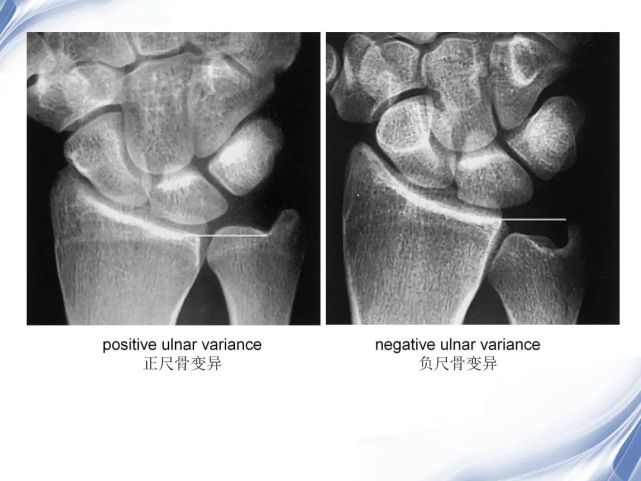 【每日学术】腕关节-x线解剖图解
