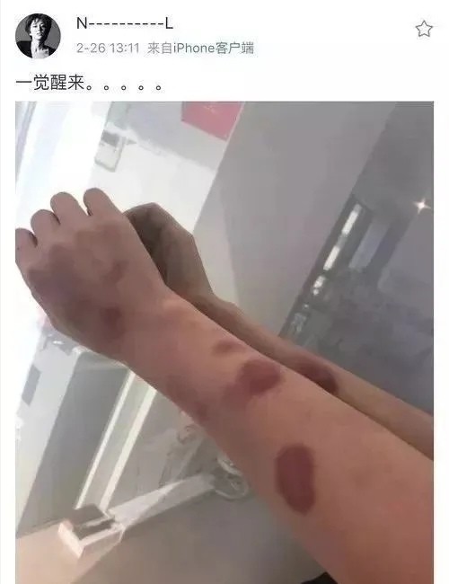 而前后脚王雨馨已发布了一张满是伤痕的手臂,之后点赞了关于家暴的