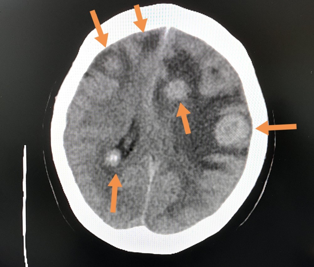ct发现10多个转移瘤(箭头),伴有广泛的瘤周水肿,周围灰色区域都是脑