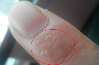 一到夏天手指就长小水泡,是抠脚导致"脚气"蔓延?