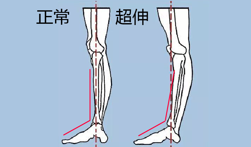 腿粗膝盖疼你可能只是膝超伸了4招教你解决
