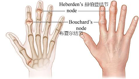 手部关节疼痛,肿胀,晨僵?你可能得了"手骨性关节炎"!_腾讯新闻