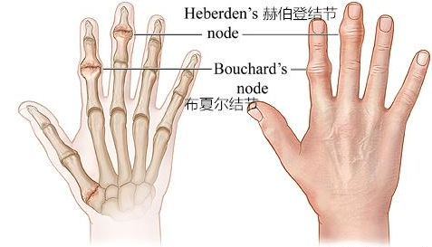 手部关节疼痛肿胀晨僵你可能得了手骨性关节炎