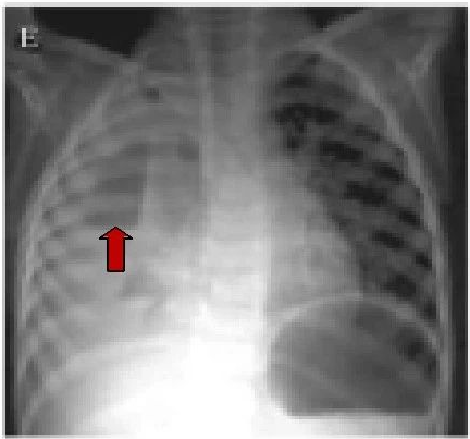 03 气液平征 气液平表明存在肺脓肿或带有支气管胸膜瘘的脓胸.