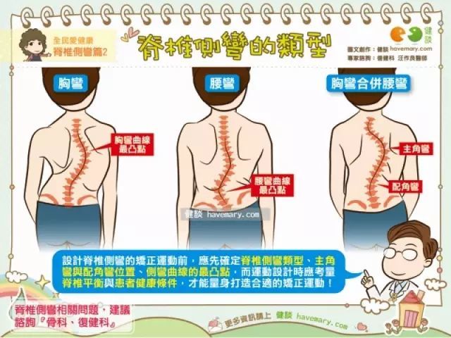 12胸椎与腰椎1,2,3节,这种类型的脊椎侧弯会伴随左侧背肌突出