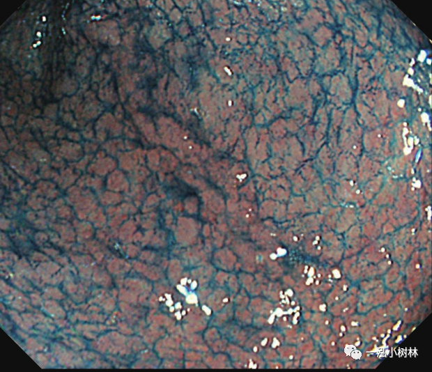 胃黏膜肠上皮化生内镜诊断
