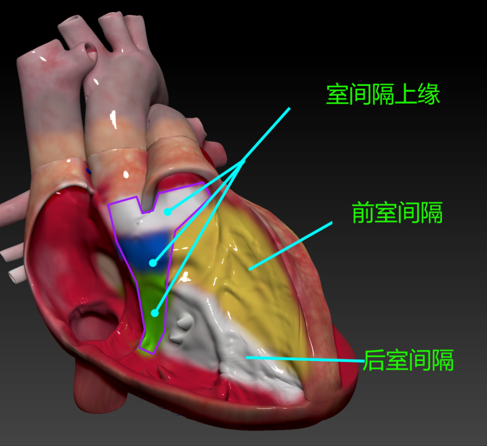 室间隔上缘,前室间隔和后室间隔的解剖示意图. 图5.