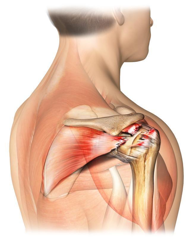 导致肩膀疼的常见七种疾病是什么?有什么特点,医生详细告诉您