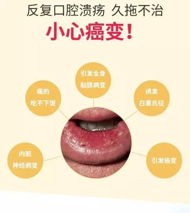 为什么总是发生口腔溃疡?医生告诉您:这样预防和治疗